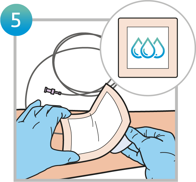Cover the ODS with a suitable absorbent dressing. It is important to seal around the dressing edge to capture the oxygen produced underneath. Do so either use a dressing with an adhesive border, cover with a bandage, or secure the edge with adhesive tape.